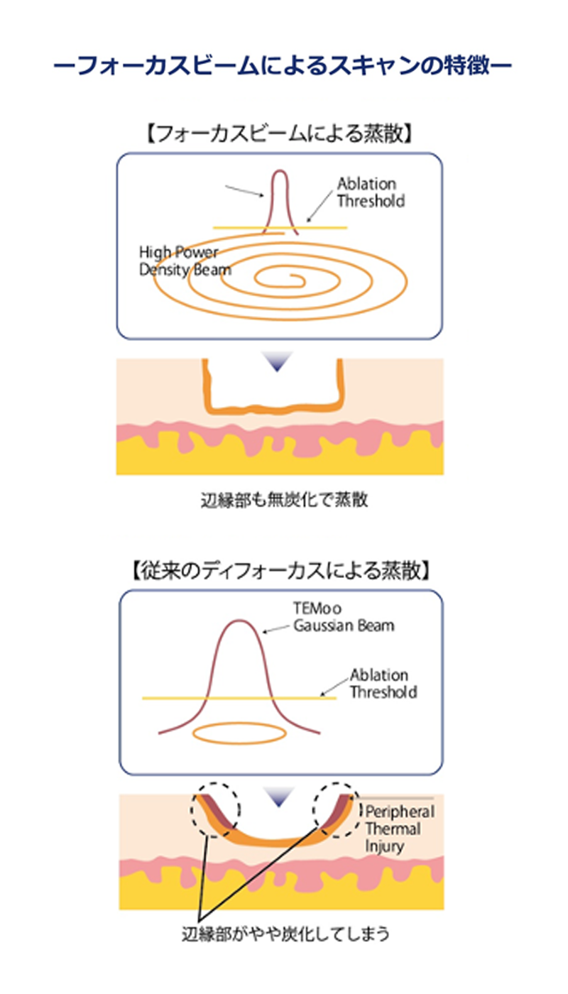 浦和のオジスキンクリニック-スキャナ付CO2レーザー