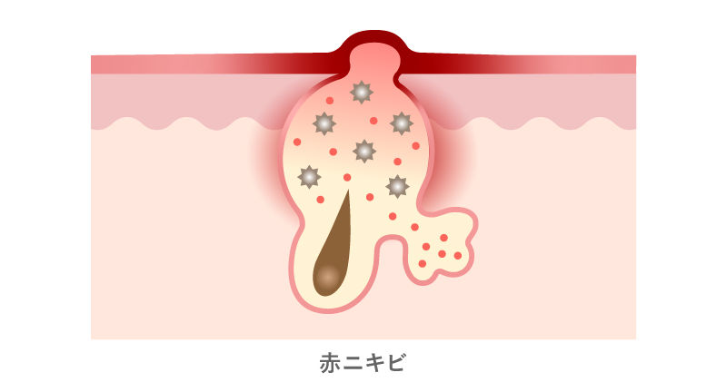 浦和のオジスキンクリニック-繰り返しできる頑固なニキビへの特効薬 - イソトレチノイン