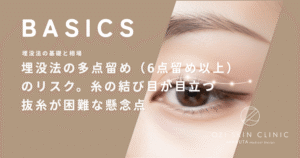 埋没法の多点留め（6点留め以上）のリスク｜糸の結び目が目立つ・抜糸が困難な懸念点
