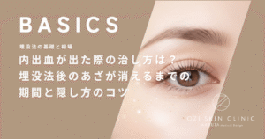 内出血が出た際の治し方は？埋没法後のあざが消えるまでの期間と隠し方のコツ