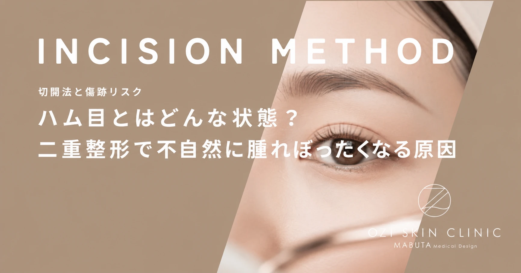 ハム目とはどんな状態？二重整形で不自然に腫れぼったくなる原因