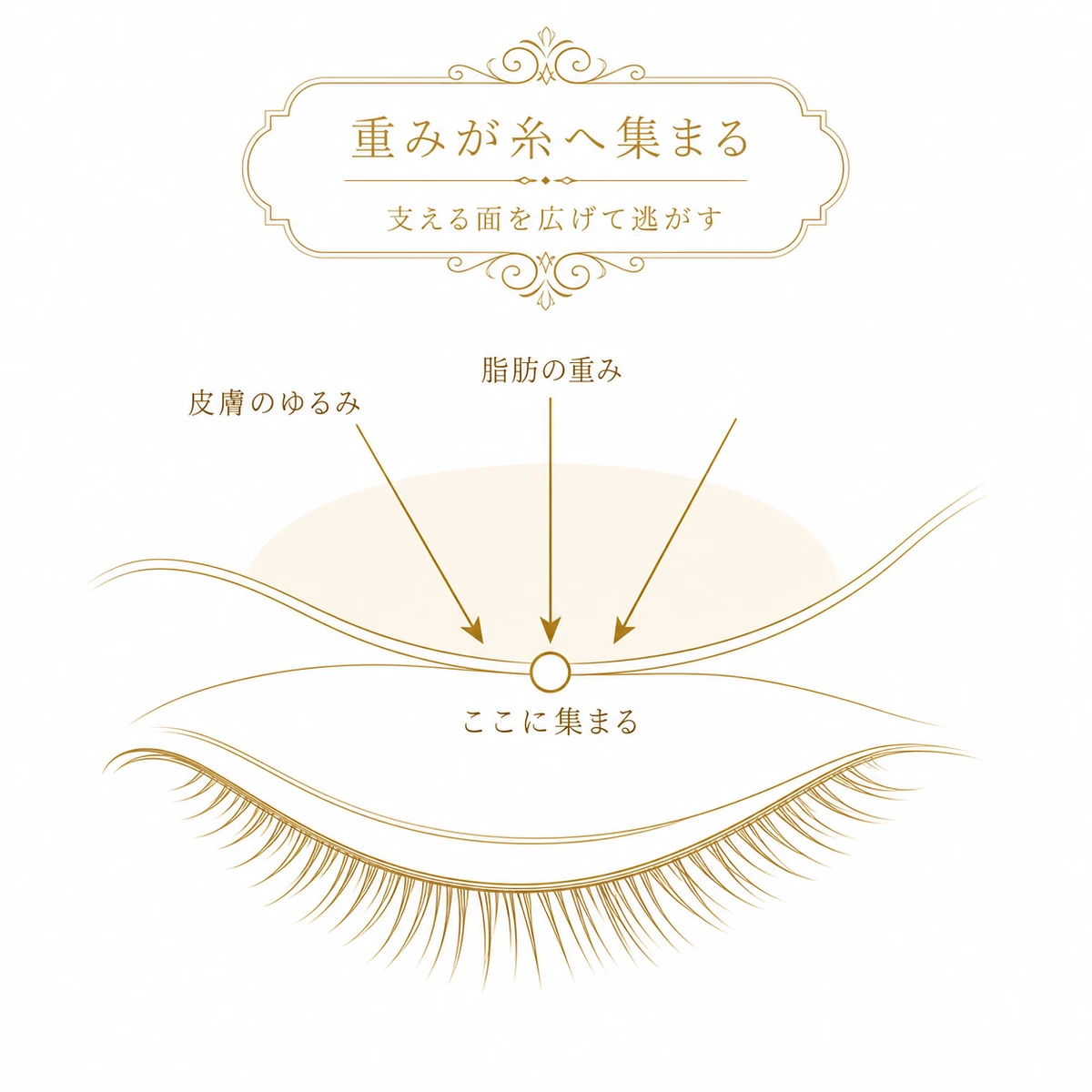 皮膚のゆるみと脂肪の重みが二重を留めた糸の一点へ集まっていくことを、下向きの矢印で示した図解イラスト