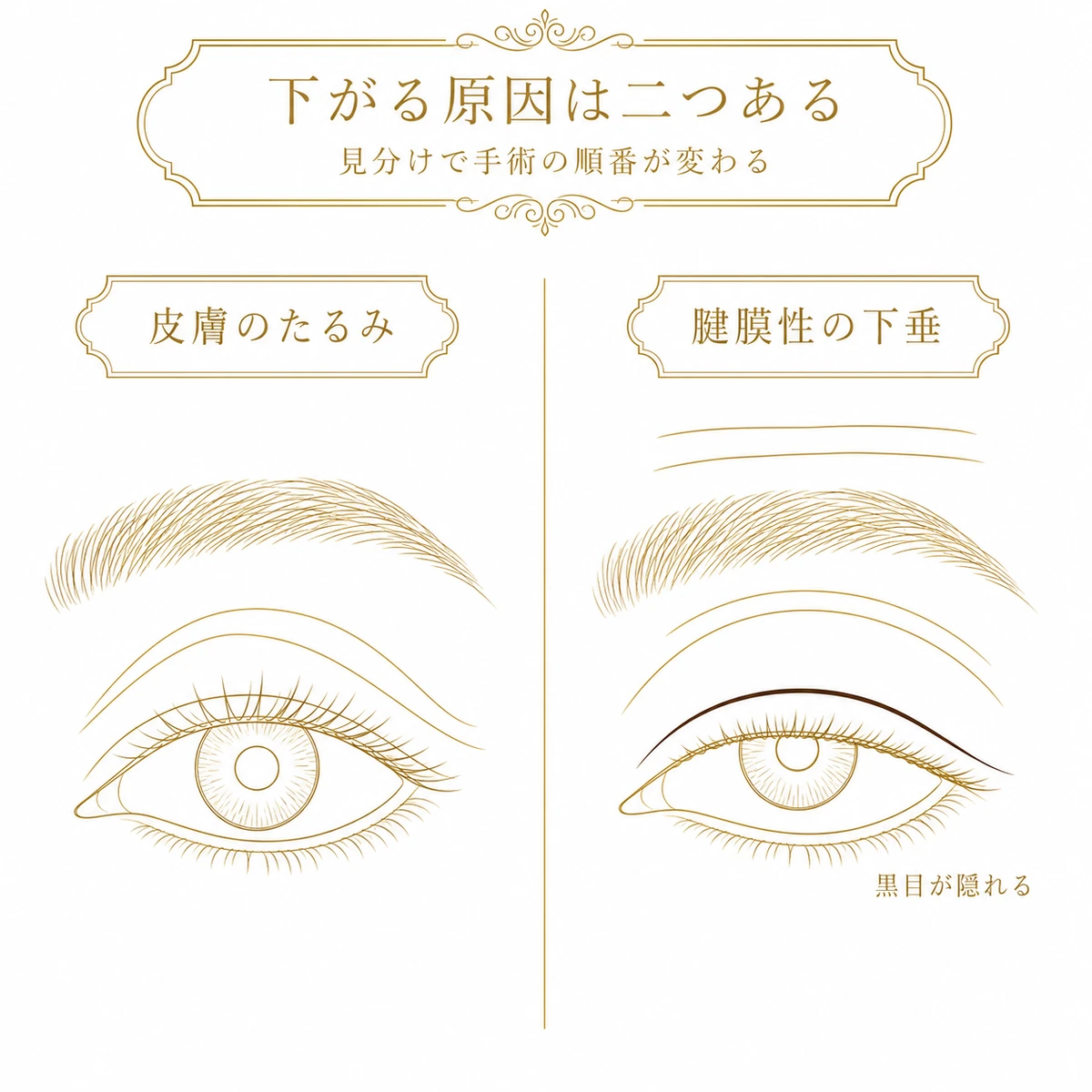 まぶたが下がって見える原因を皮膚のたるみと腱膜性の下垂に分け、黒目の見える範囲の違いで見分ける2パネルの図解イラスト