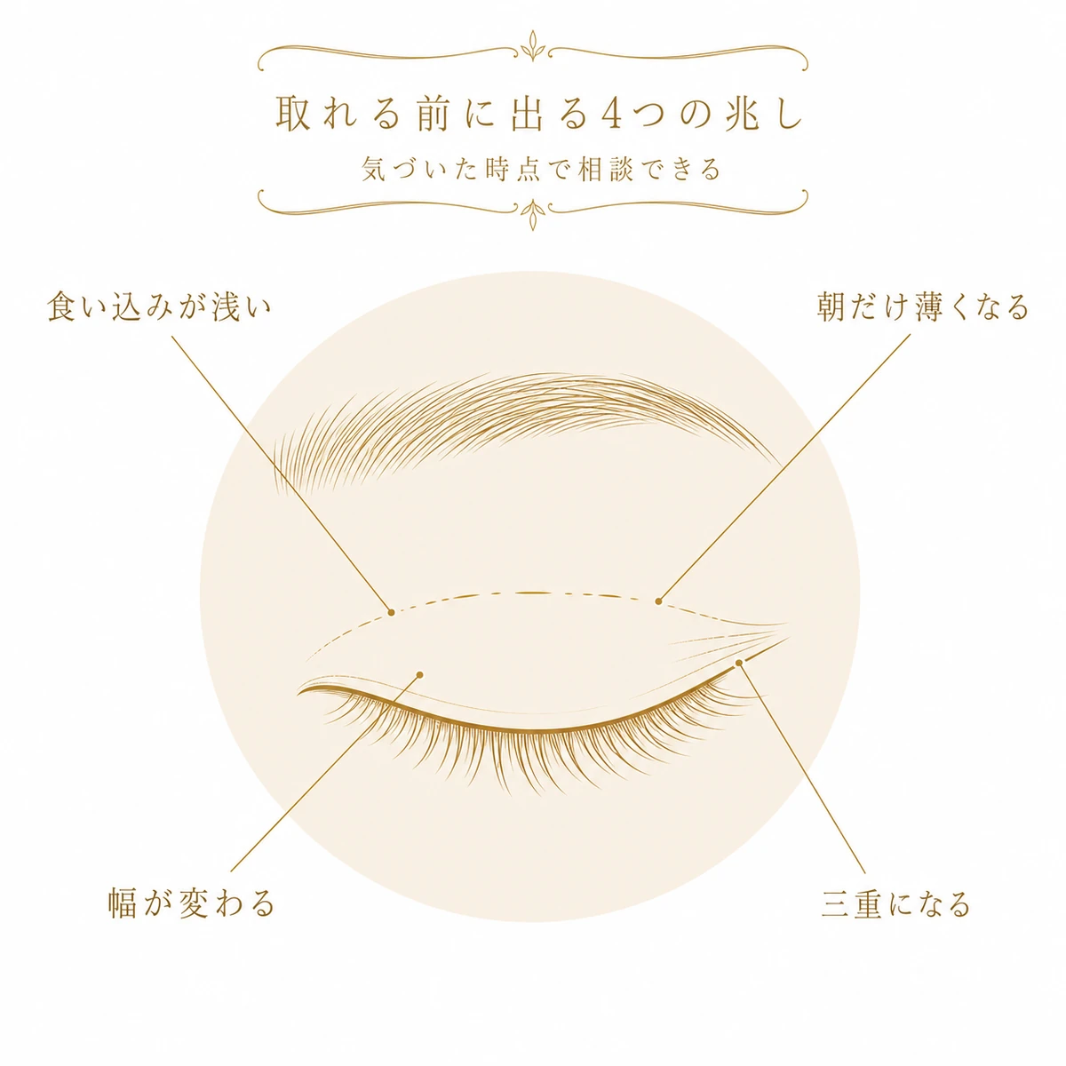 埋没法が取れる前に出る4つの兆しを、二重の線が浅くなった目元から引き出し線で指し示した図解イラスト
