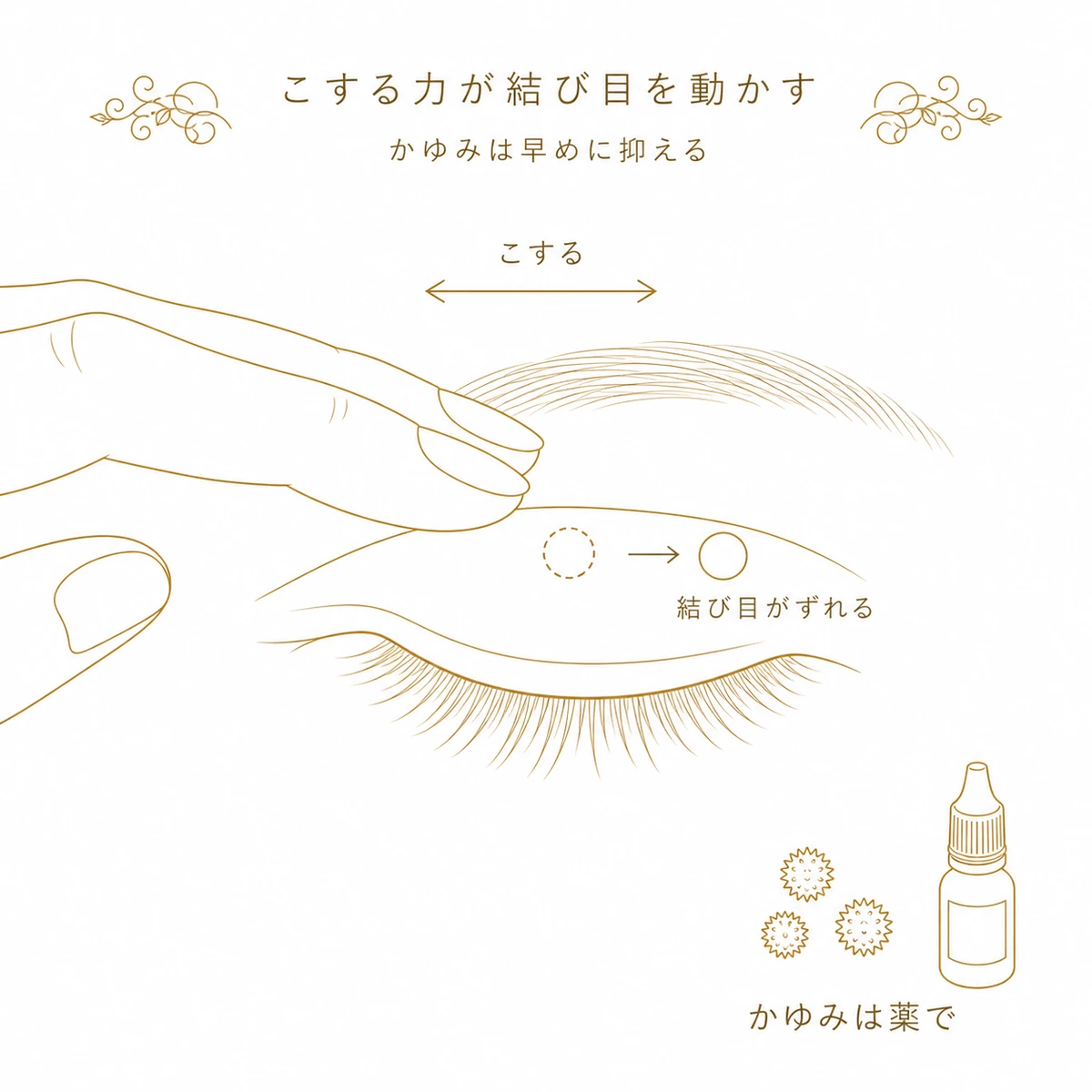 目をこする横向きの力が埋没法の糸の結び目を少しずつずらすことを、往復する矢印とずれた結び目で示した図解イラスト