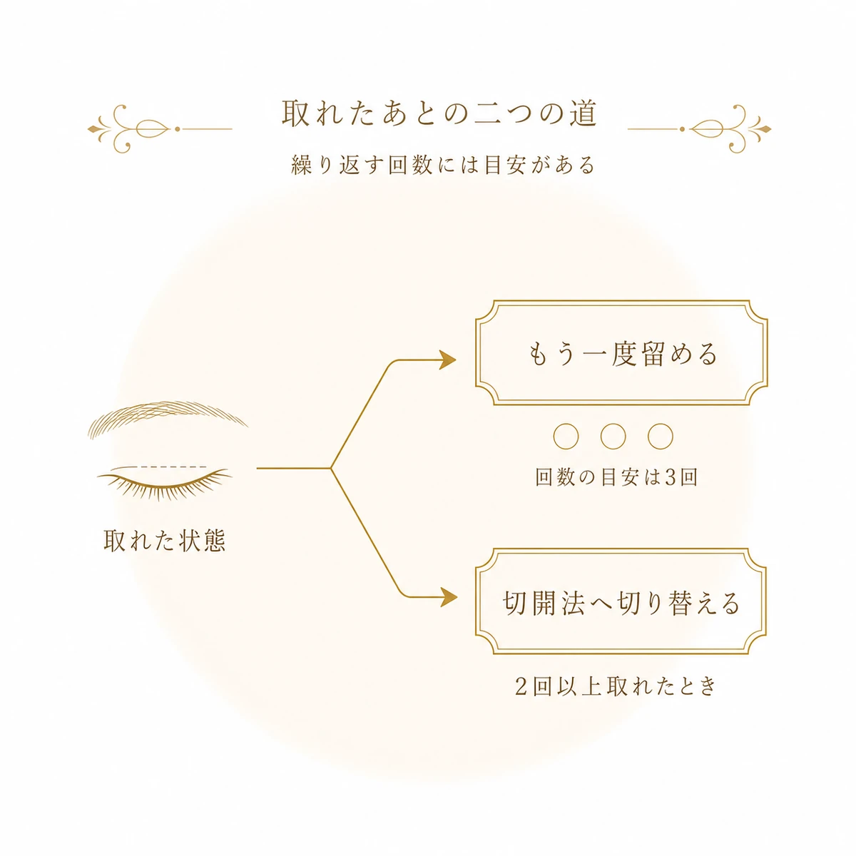 埋没法が取れたあとの選択肢が、もう一度留める道と切開法へ切り替える道の二手に分かれることを示した図解イラスト