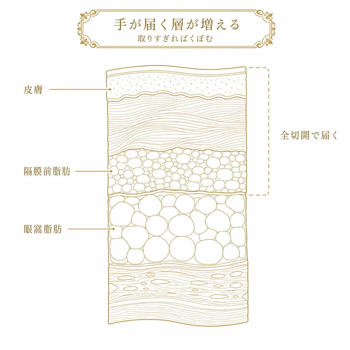 上まぶたの断面を5つの層に分け、全切開では皮膚から隔膜前脂肪までまとめて手が届くことを破線の囲いで示した図解イラスト