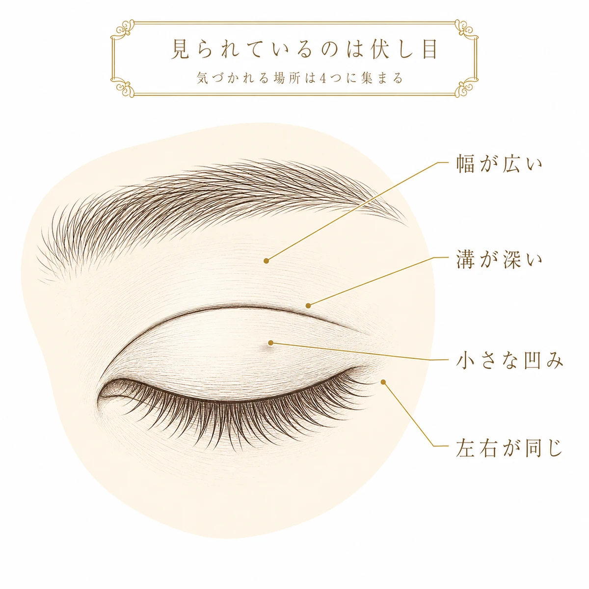 伏し目にした目元を拡大し、二重整形で周囲に気づかれやすい幅・溝・凹み・左右差の4か所を引き出し線で指し示した図解イラスト