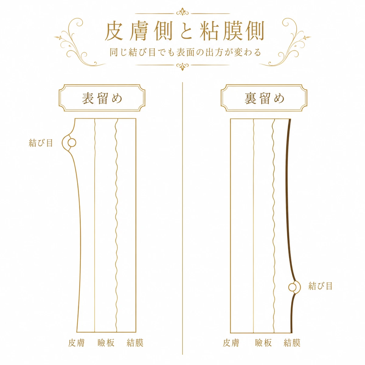 上まぶたの断面を左右に並べ、表留めは皮膚のすぐ下、裏留めは結膜の側に糸の結び目を置くという違いを示した図解イラスト