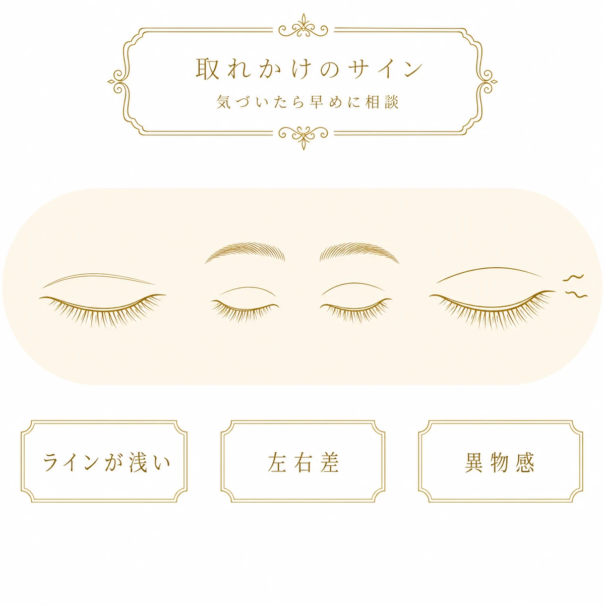 埋没法が取れかけているときのサインを、ラインが浅い・左右差・異物感の3つの目元で並べて示した図解イラスト