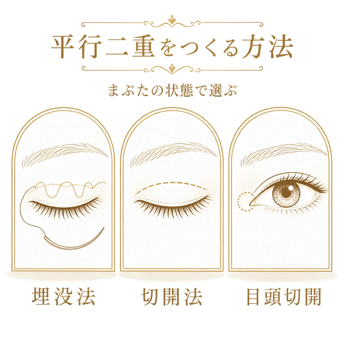 平行二重を作る埋没法、切開法、目頭切開を並べた図