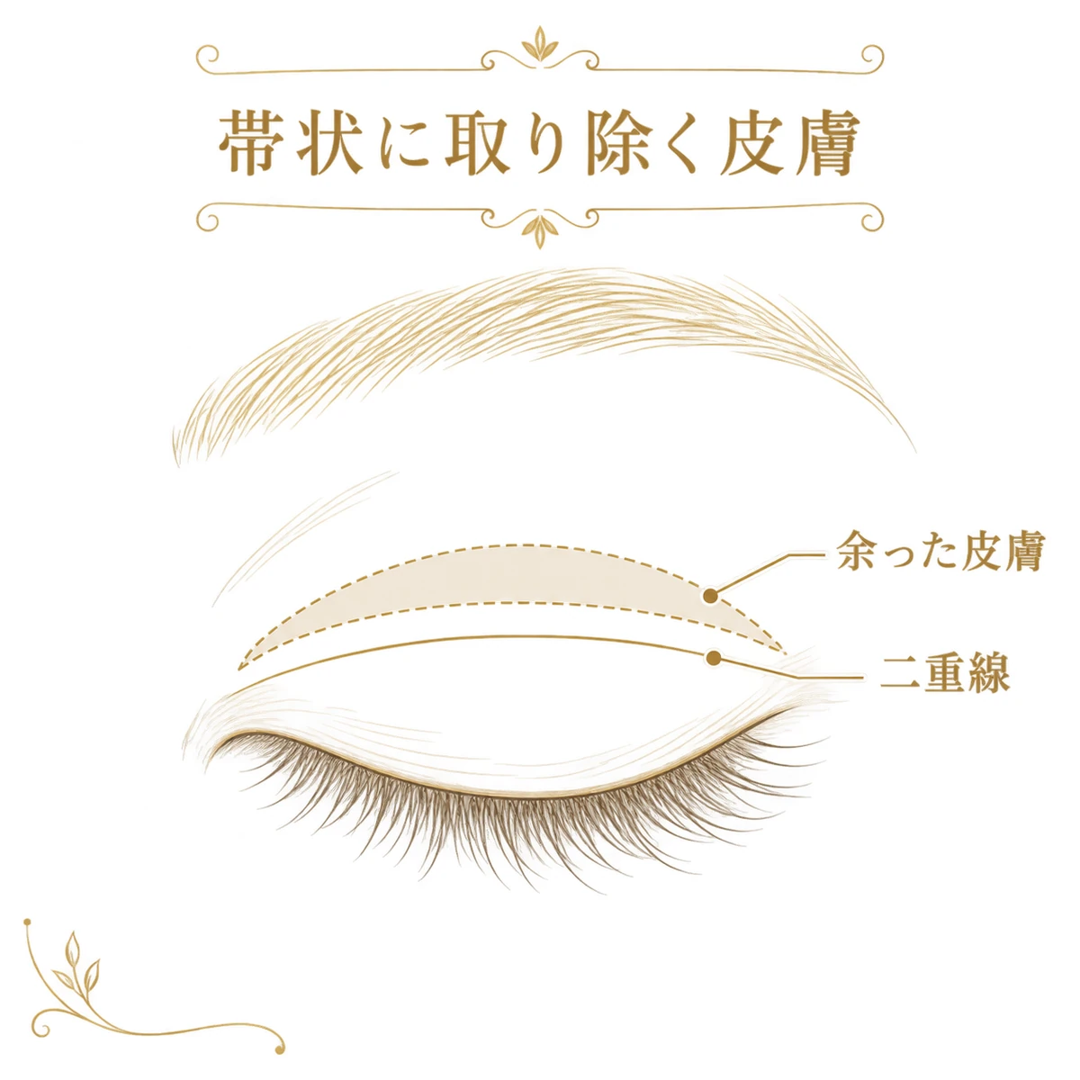予定する二重線の上側で帯状に取り除く、余ったまぶたの皮膚を示した線画