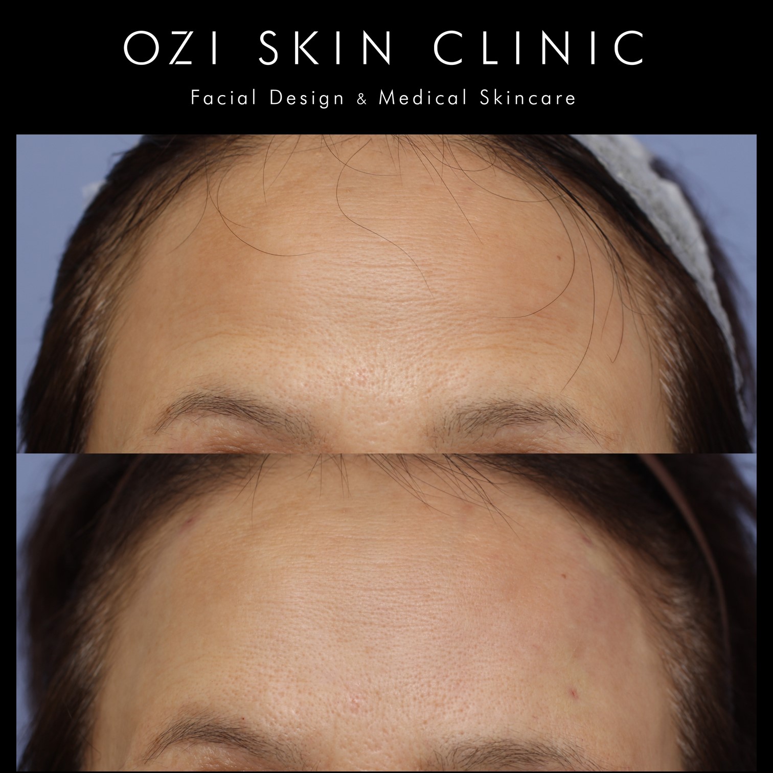 Ozi Skin 浦和駅1分の美容皮膚科 まぶたの治療 Ozi Skin Clinic