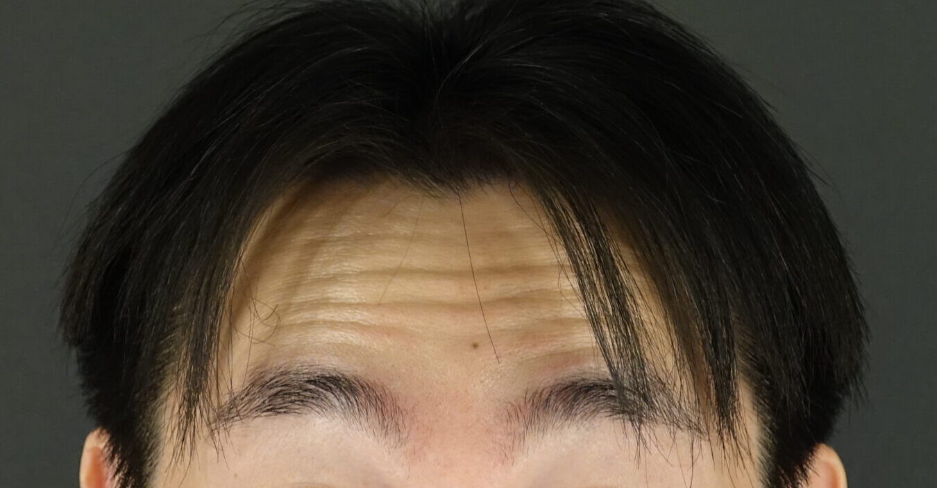 おでこ 額 のボトックスでまぶたが重く 眼瞼下垂なの ボトックスは打てないの 浦和駅1分の美容皮膚科 まぶたの治療 Ozi Skin Clinic