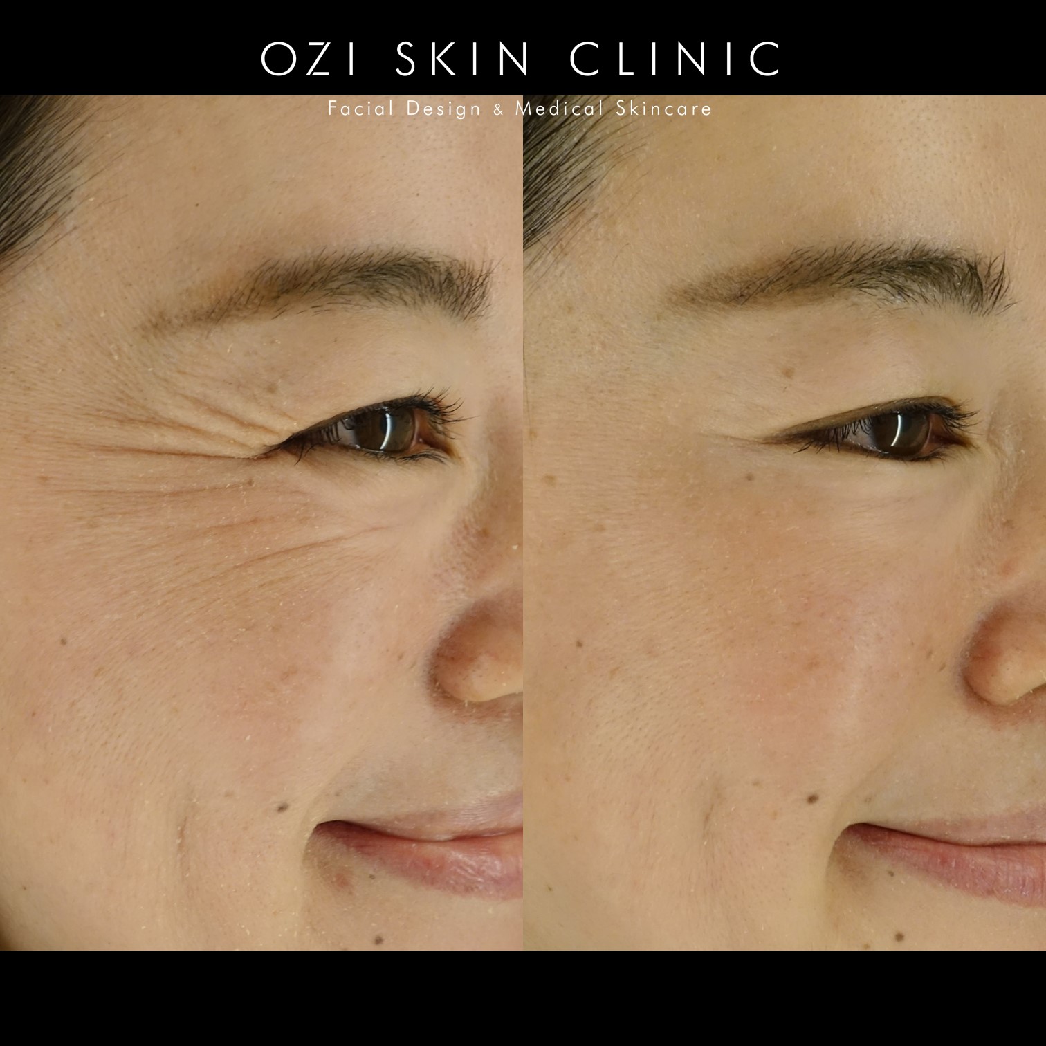 Ozi Skin 浦和駅1分の美容皮膚科 まぶたの治療 Ozi Skin Clinic Ozi Skin 浦和駅1分の美容皮膚科 まぶたの治療 Ozi Skin Clinic