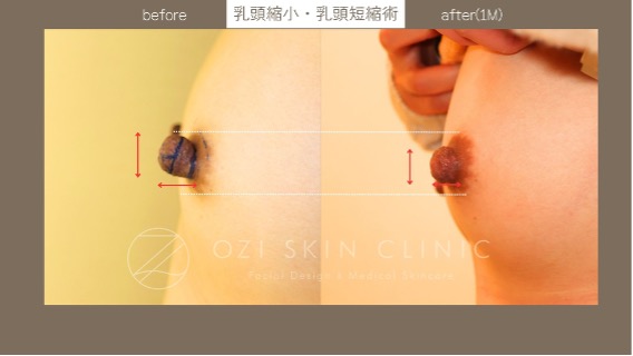 乳頭縮小術　症例写真　形成外科専門医
