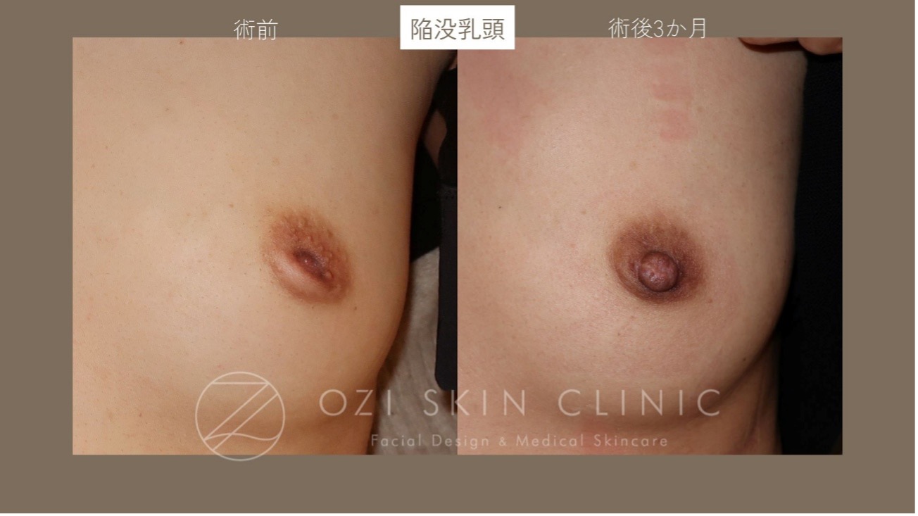 陥没乳頭　症例写真　形成外科専門医