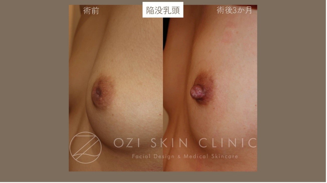 陥没乳頭　症例写真　形成外科専門医