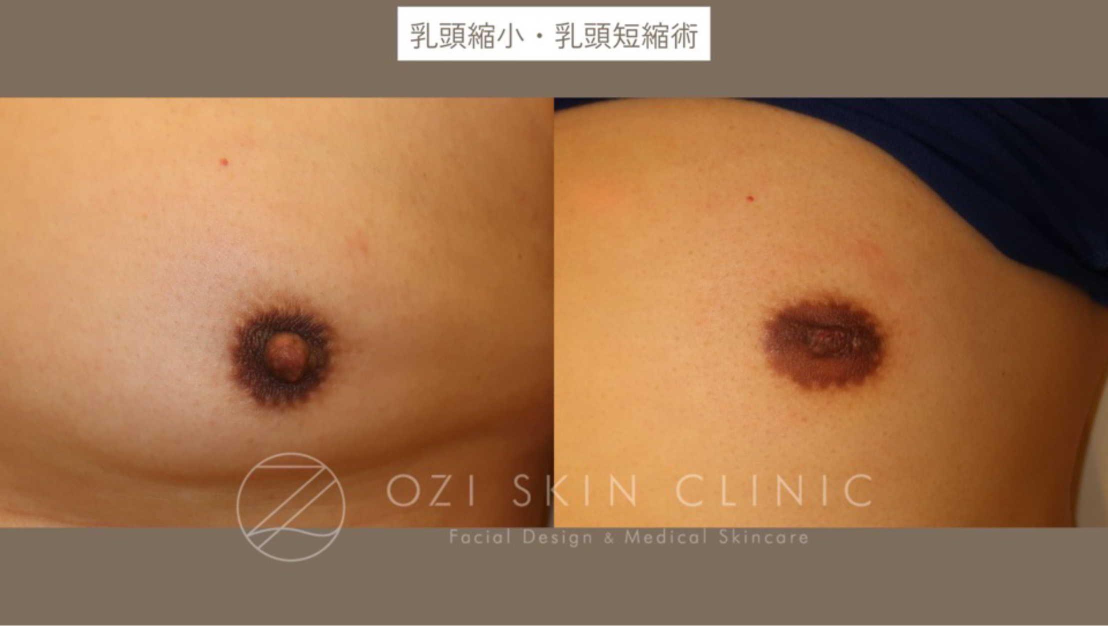 男性乳頭縮小 術前 症例写真 大宮 埼玉 形成外科専門医