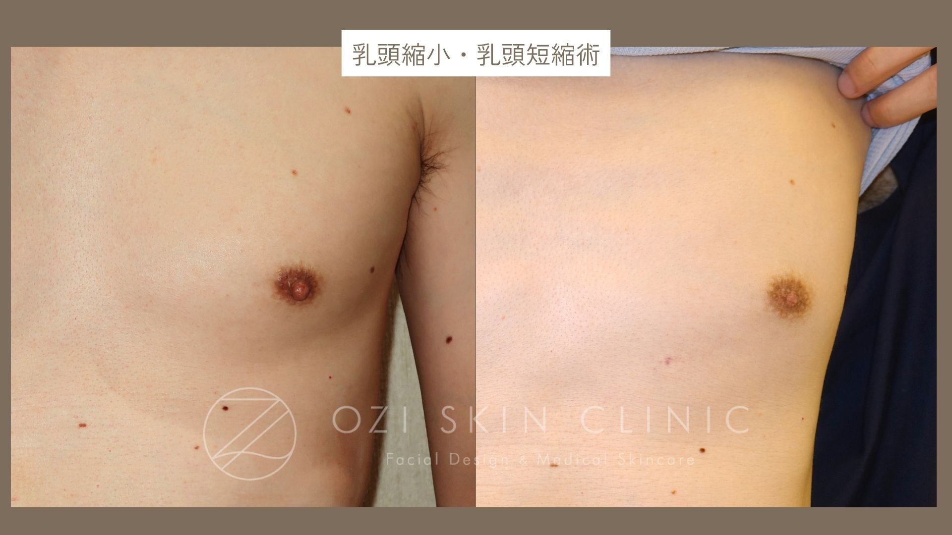 男性乳頭縮小術の術前と術後3か月の正面症例写真