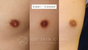 男性乳頭縮小術の術前から術後1か月・3か月までの経過写真